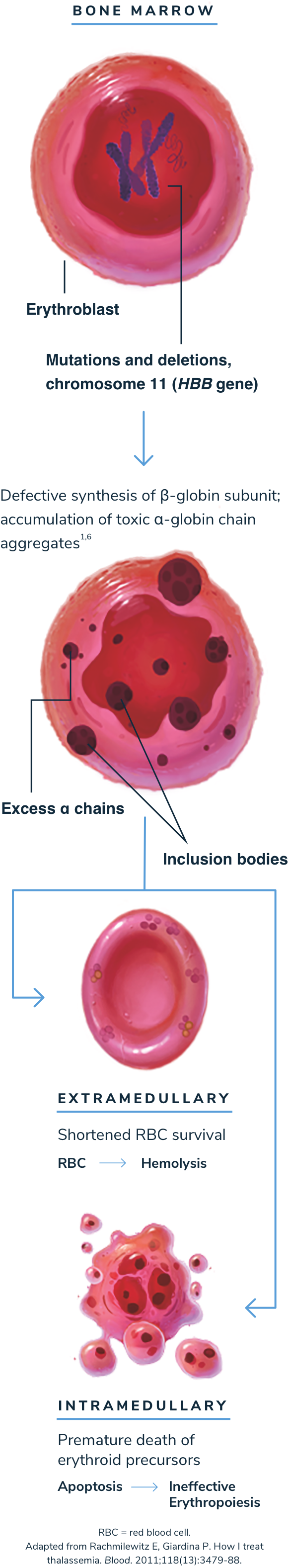 Illustration showing beta thalassemia pathophysiology via ineffective erythropoiesis and hemolysis
